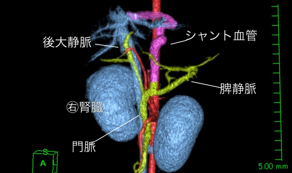 犬の門脈体循環シャント（PSS）血管結紮術