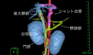 犬の門脈体循環シャント（PSS）血管結紮術