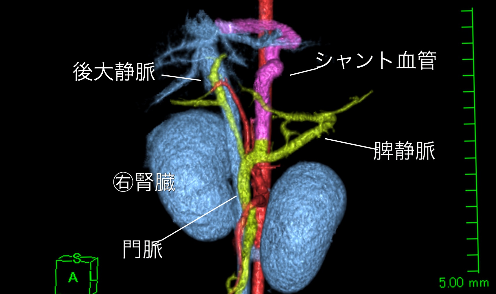 犬の門脈体循環シャント（PSS）血管結紮術